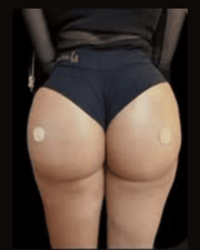 Depois do procedimento de Harmonização Corporal